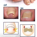 image_showing_application_process - لاصق تصحيح أظافر القدم