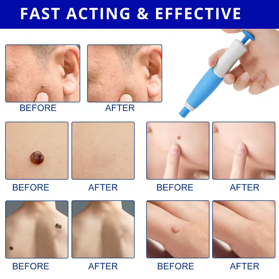 images/skin_tag_removal_2.jpg - Skin Tag Removal kit إزالة الزوائد الجلدية دون أي ألم أو إزعاج